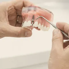 Manos mostrando una prótesis dental sobre implantes